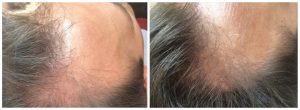 Hair regrowth 