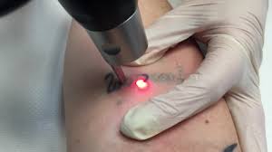 laser tattoo removal london ontario